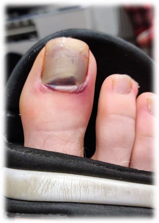 badminton toe injury v1